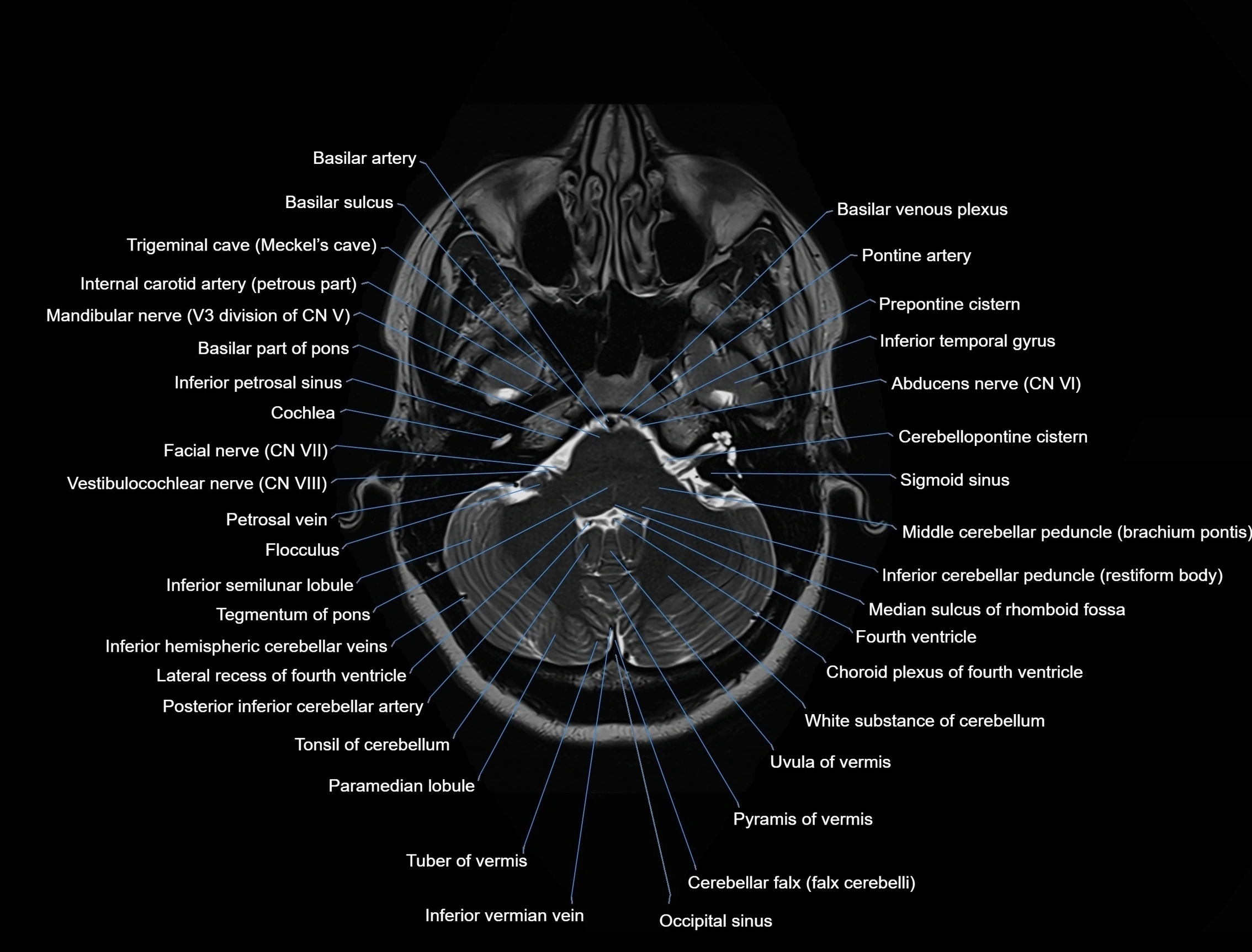 MRI Brain axial cross sectional radiology anatomy 3T image  -img-00001-00012.webp